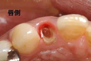 唇側