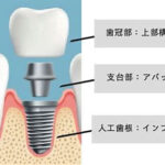 1本の歯を失ってしまった方の治療法