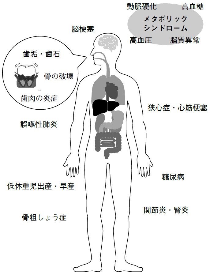 【図表】歯周病が全身に及ぼす影響参考：日本臨床歯周病学会HP