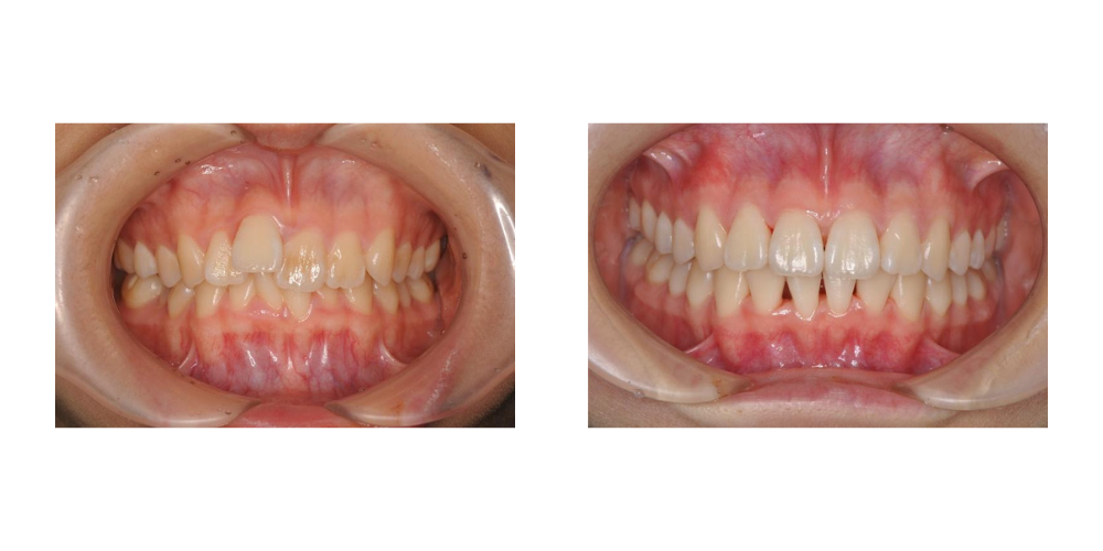 歯科矯正の例