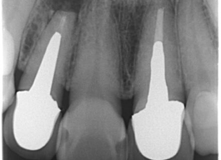 8年経過したインプラント症例:前歯の違和感を訴える40代女性患者