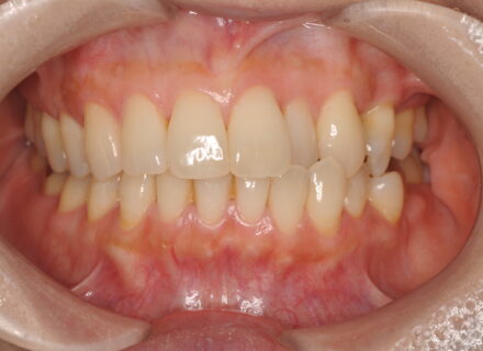 あきらめていた頭痛と耳鳴り、原因は歯の「かみ合わせ」だった？