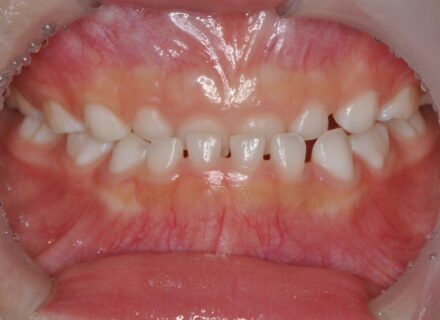 子どもの受け口は早期対応が鍵。放置が招く将来のデメリットとは