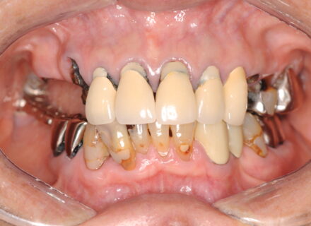 インプラントの費用対効果